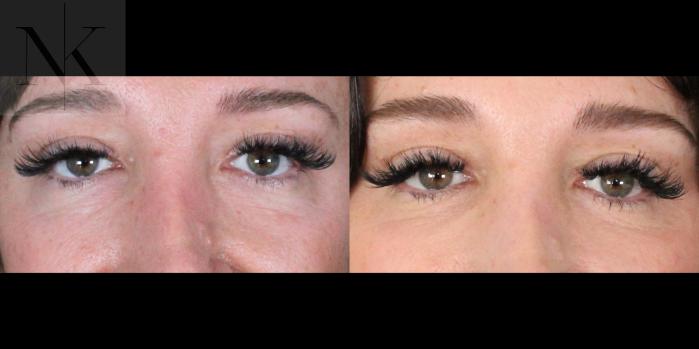Before & After Lower Blepharoplasty Case 175 Front View in Wethersfield, Hartford, Nebraska