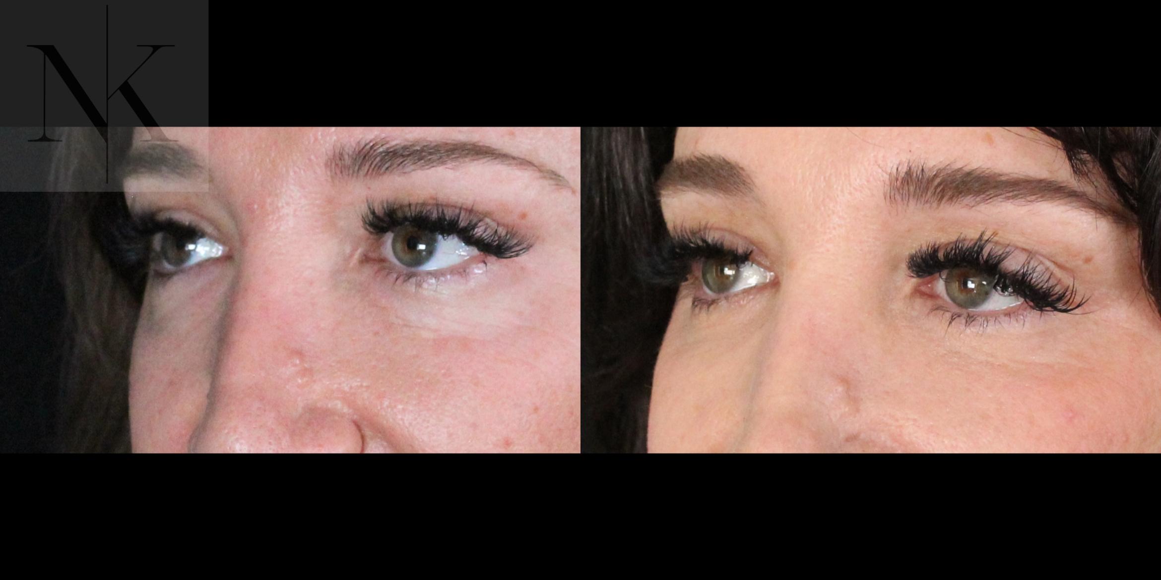Before & After Lower Blepharoplasty Case 175 Left Oblique View in Wethersfield, Hartford, Nebraska