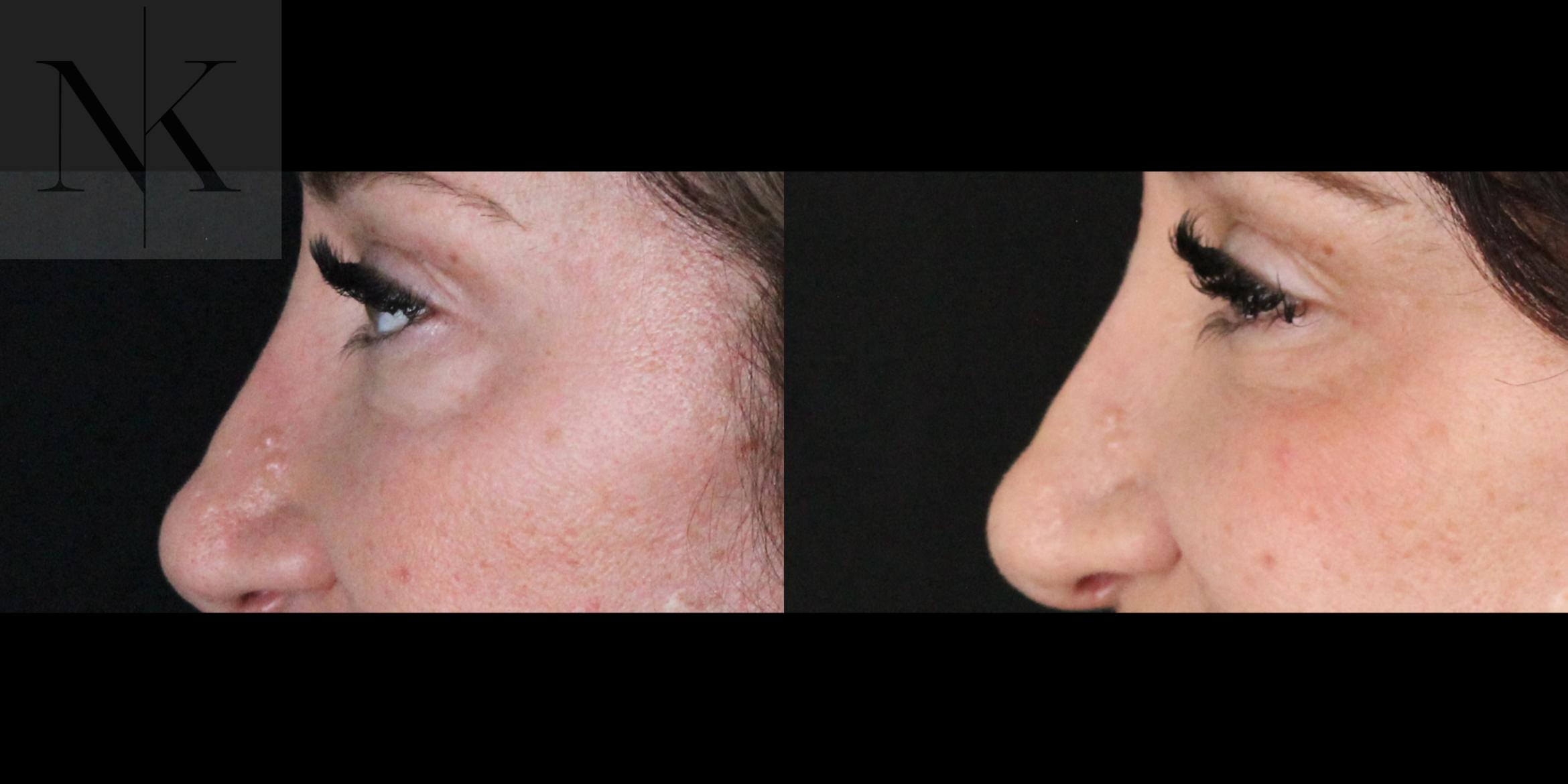 Before & After Lower Blepharoplasty Case 175 Left Side View in Wethersfield, Hartford, Nebraska