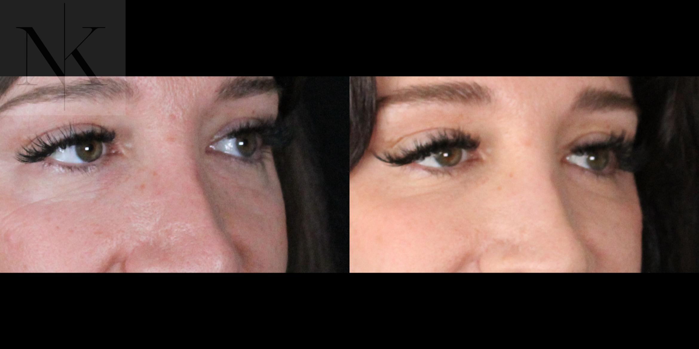 Before & After Lower Blepharoplasty Case 175 Right Oblique View in Wethersfield, Hartford, Nebraska