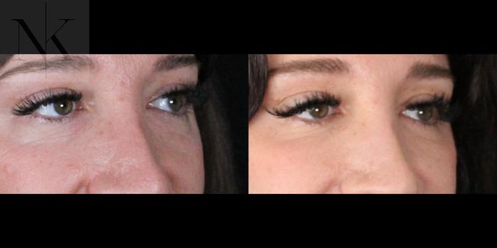 Before & After Lower Blepharoplasty Case 175 Right Oblique View in Wethersfield, Hartford, Nebraska