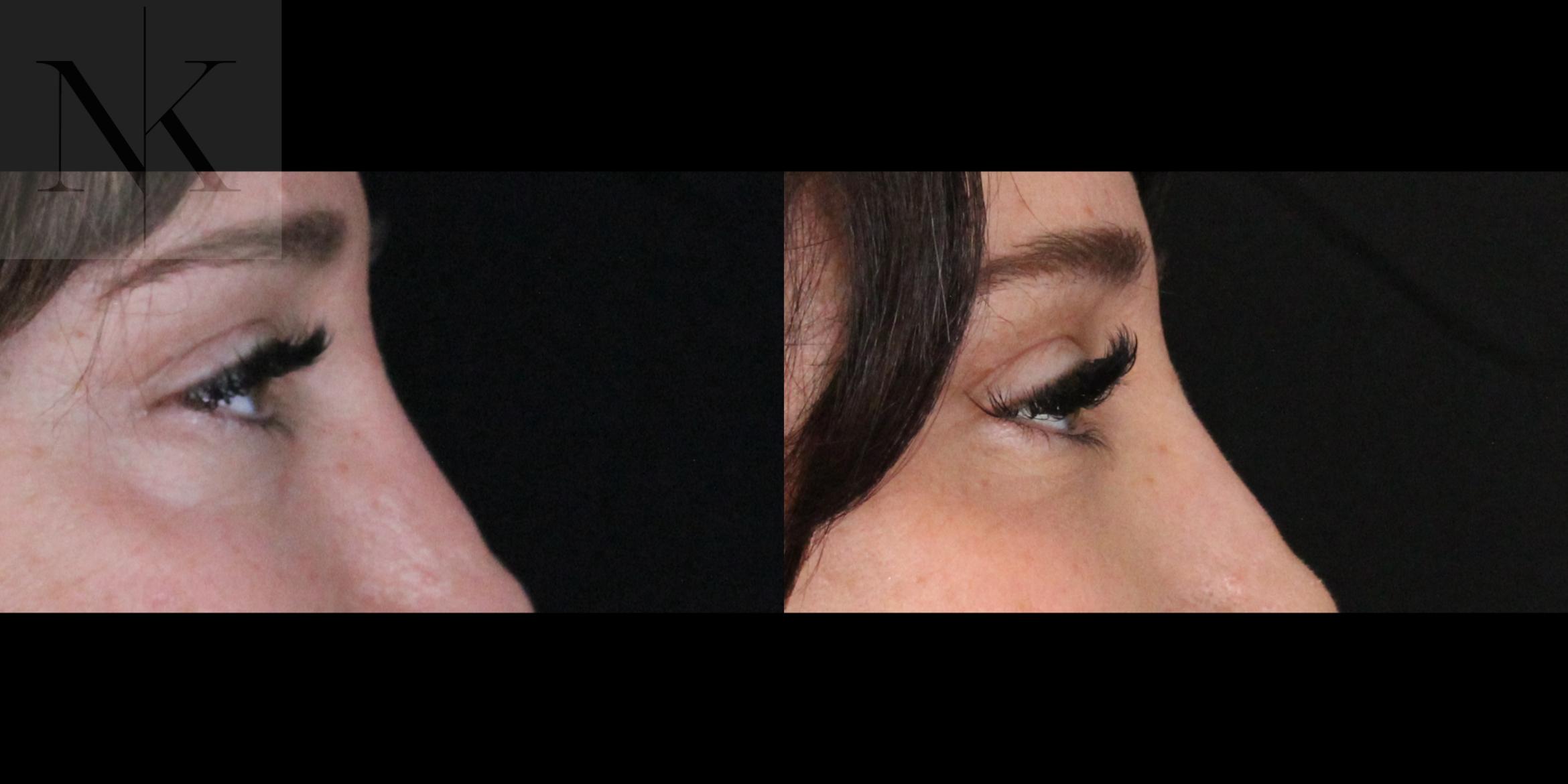 Before & After Lower Blepharoplasty Case 175 Right Side View in Wethersfield, Hartford, Nebraska