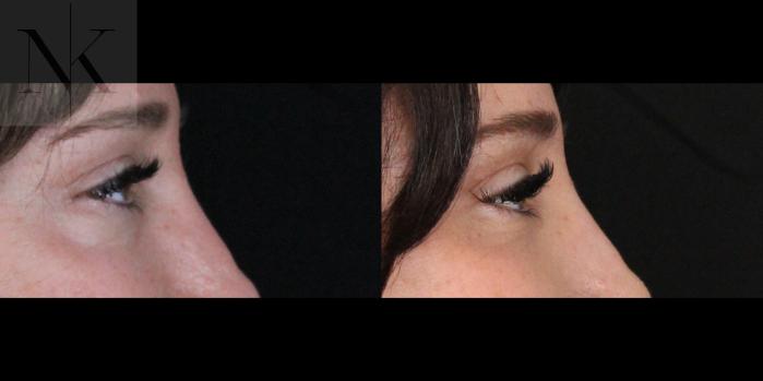 Before & After Lower Blepharoplasty Case 175 Right Side View in Wethersfield, Hartford, Nebraska