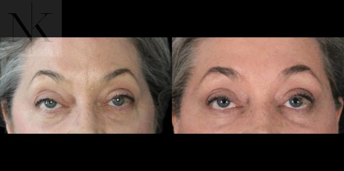 Before & After Lower Blepharoplasty Case 179 Front View in Wethersfield, Hartford, Nebraska