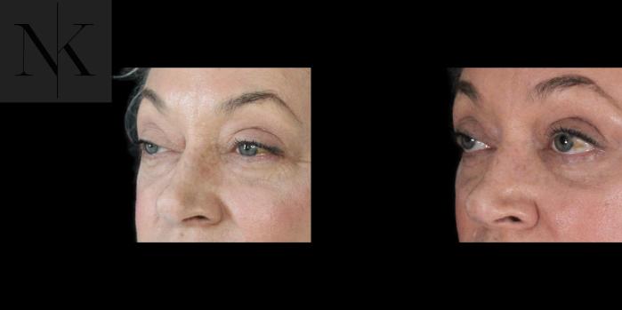 Before & After Lower Blepharoplasty Case 179 Left Oblique View in Wethersfield, Hartford, Nebraska