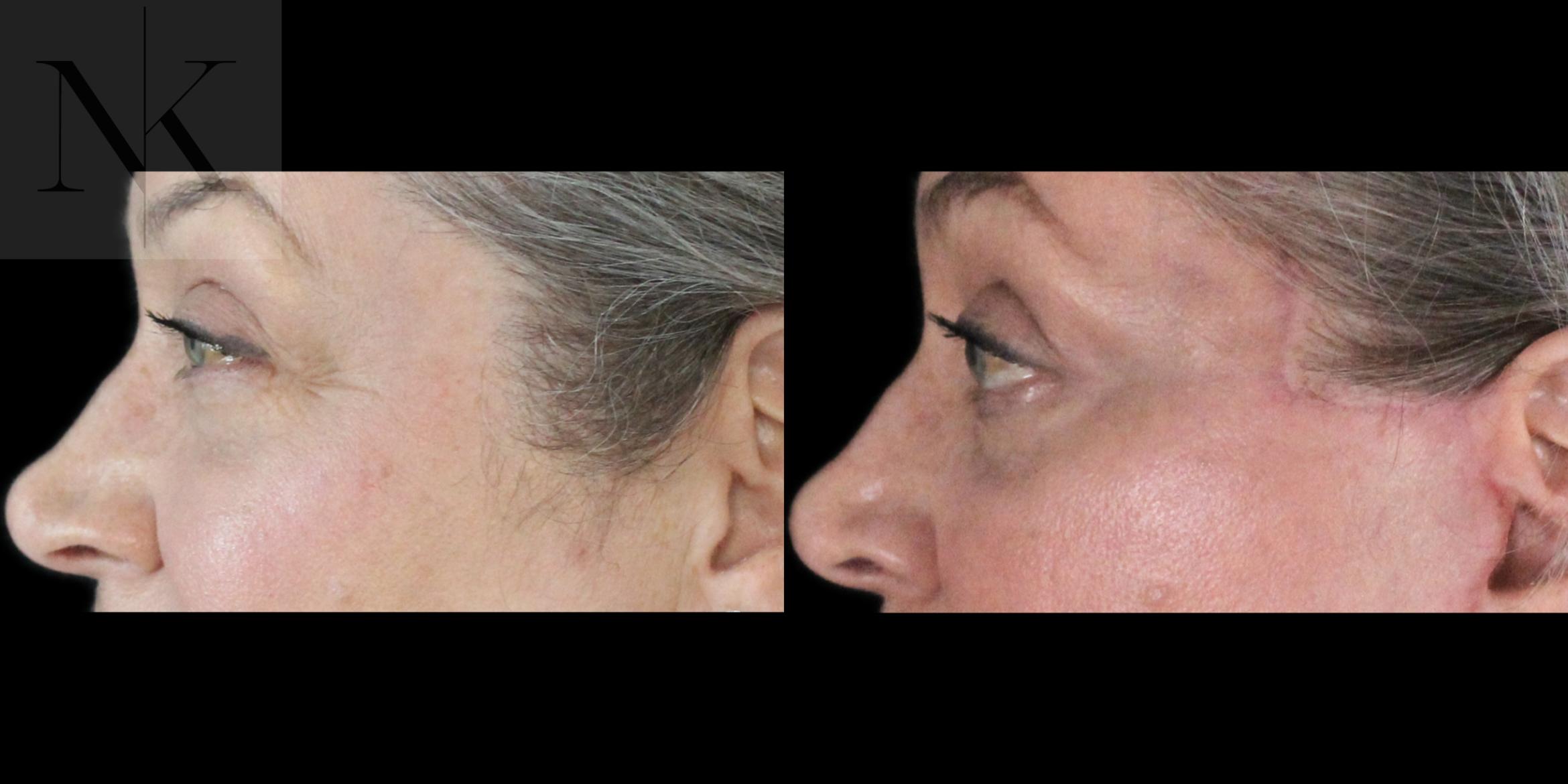 Before & After Lower Blepharoplasty Case 179 Left Side View in Wethersfield, Hartford, Nebraska