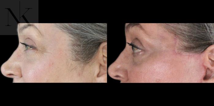 Before & After Lower Blepharoplasty Case 179 Left Side View in Wethersfield, Hartford, Nebraska
