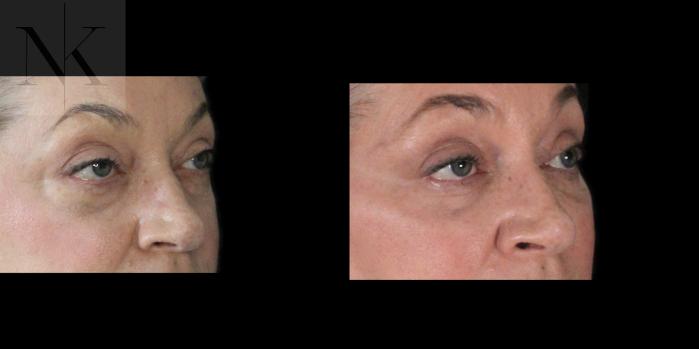 Before & After Lower Blepharoplasty Case 179 Right Oblique View in Wethersfield, Hartford, Nebraska