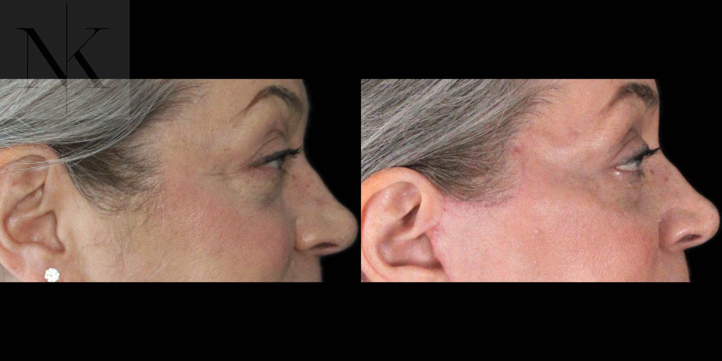 Before & After Lower Blepharoplasty Case 179 Right Side View in Wethersfield, Hartford, Nebraska