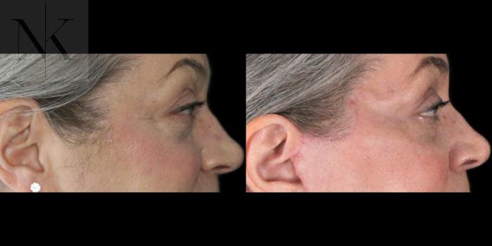 Before & After Lower Blepharoplasty Case 179 Right Side View in Wethersfield, Hartford, Nebraska