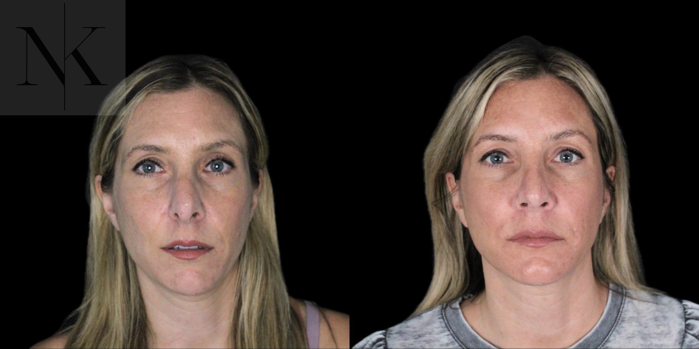 Before & After Revision Rhinoplasty Case 180 Front View in Wethersfield, Hartford, Nebraska