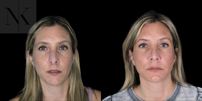 Before & After Revision Rhinoplasty Case 180 Front View in Wethersfield, Hartford, Nebraska