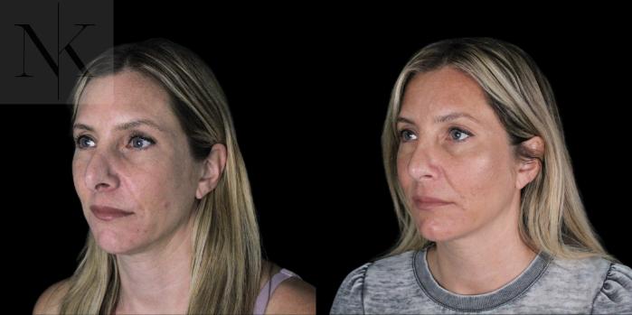 Before & After Revision Rhinoplasty Case 180 Left Oblique View in Wethersfield, Hartford, Nebraska