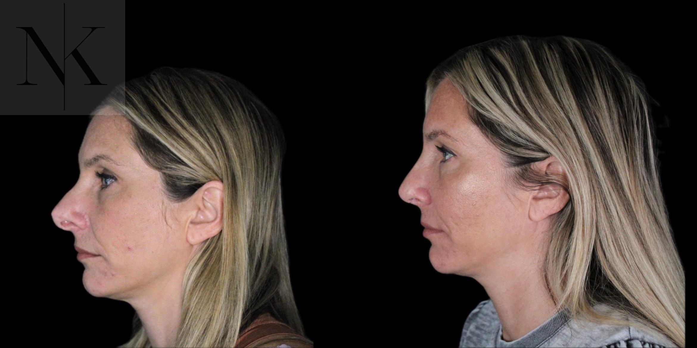 Before & After Revision Rhinoplasty Case 180 Left Side View in Wethersfield, Hartford, Nebraska