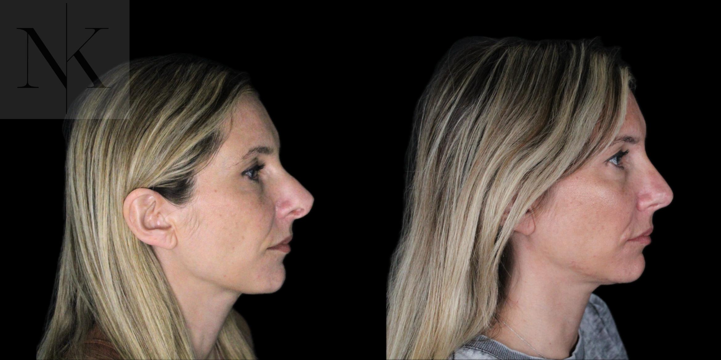 Before & After Revision Rhinoplasty Case 180 Right Side View in Wethersfield, Hartford, Nebraska
