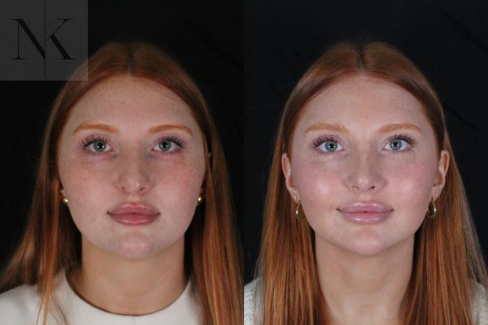 Before & After Revision Rhinoplasty Case 181 Front View in Wethersfield, Hartford, Nebraska