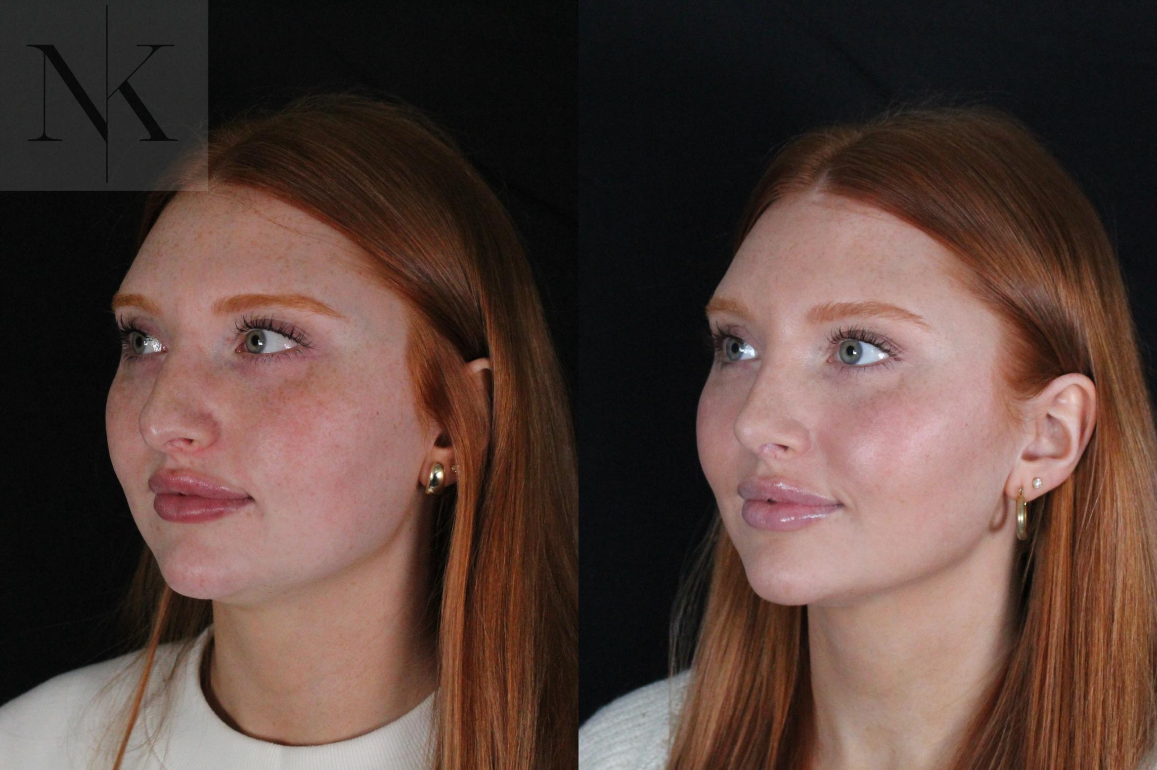 Before & After Revision Rhinoplasty Case 181 Left Oblique View in Wethersfield, Hartford, Nebraska