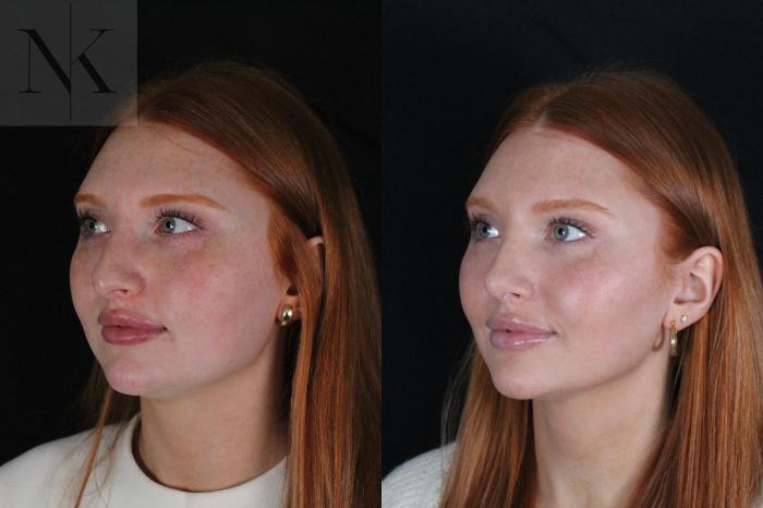 Before & After Revision Rhinoplasty Case 181 Left Oblique View in Wethersfield, Hartford, Nebraska