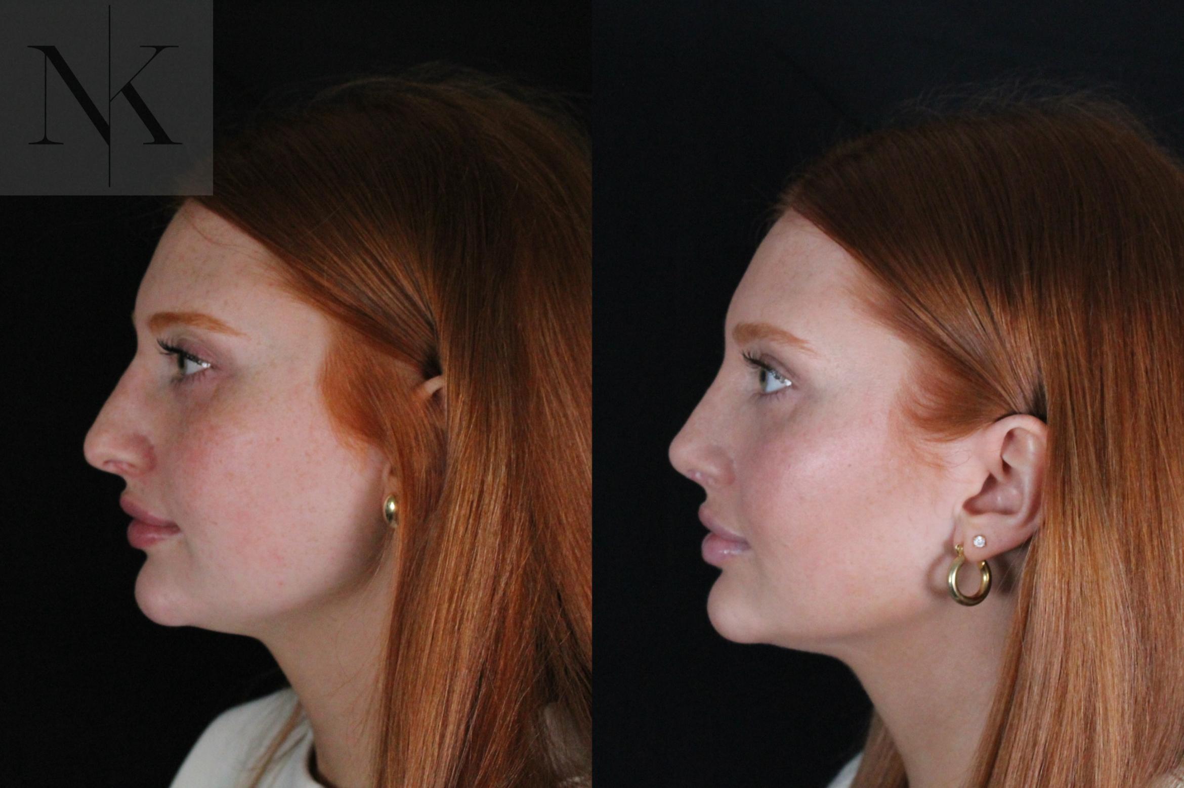 Before & After Revision Rhinoplasty Case 181 Left Side View in Wethersfield, Hartford, Nebraska
