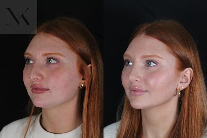 Before & After Revision Rhinoplasty Case 181 Right Oblique View in Wethersfield, Hartford, Nebraska
