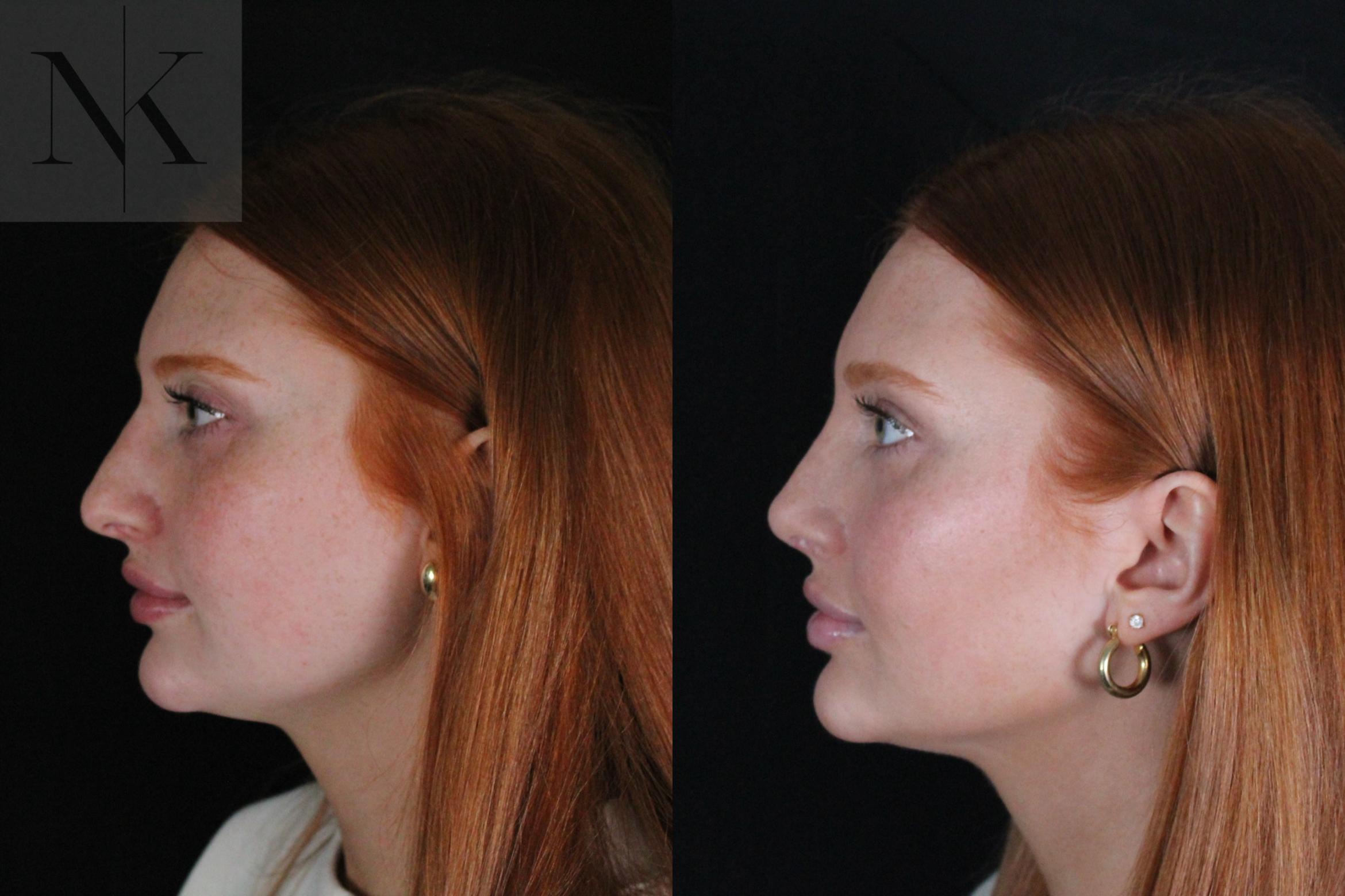 Before & After Revision Rhinoplasty Case 181 Right Side View in Wethersfield, Hartford, Nebraska