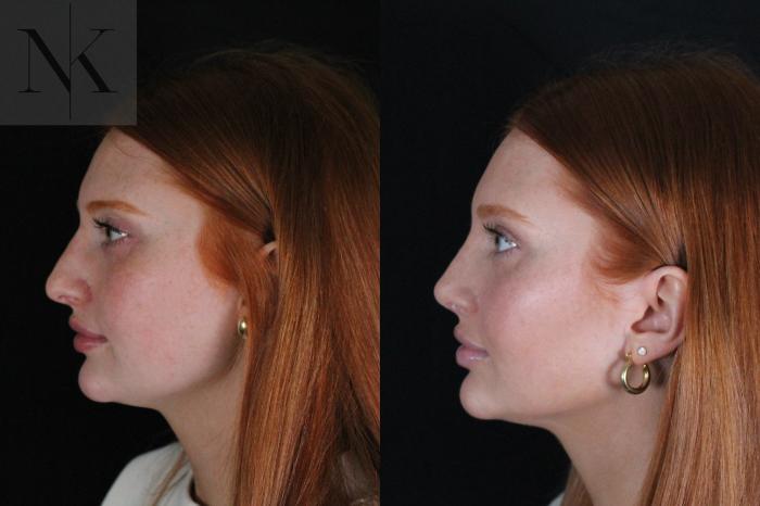 Before & After Revision Rhinoplasty Case 181 Right Side View in Wethersfield, Hartford, Nebraska