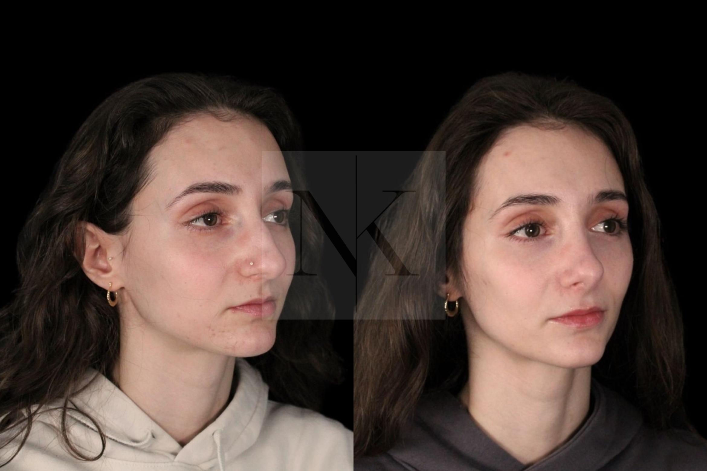 Before & After Rhinoplasty Case 128 Right Oblique View in Wethersfield, Hartford, Nebraska