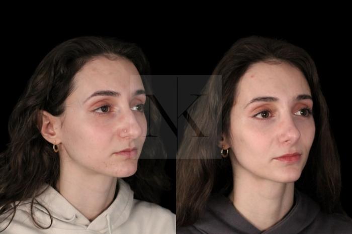 Before & After Rhinoplasty Case 128 Right Oblique View in Wethersfield, Hartford, Nebraska