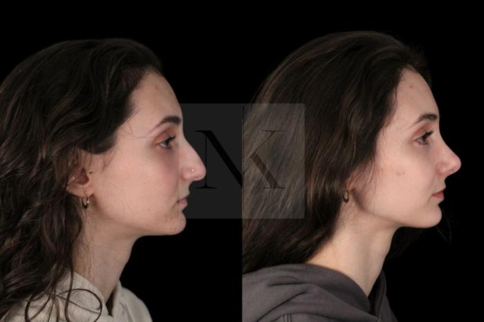 Before & After Rhinoplasty Case 128 Right Side View in Wethersfield, Hartford, Nebraska