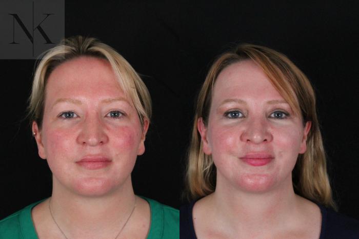 Before & After Rhinoplasty Case 188 Front View in Wethersfield, Hartford, Nebraska