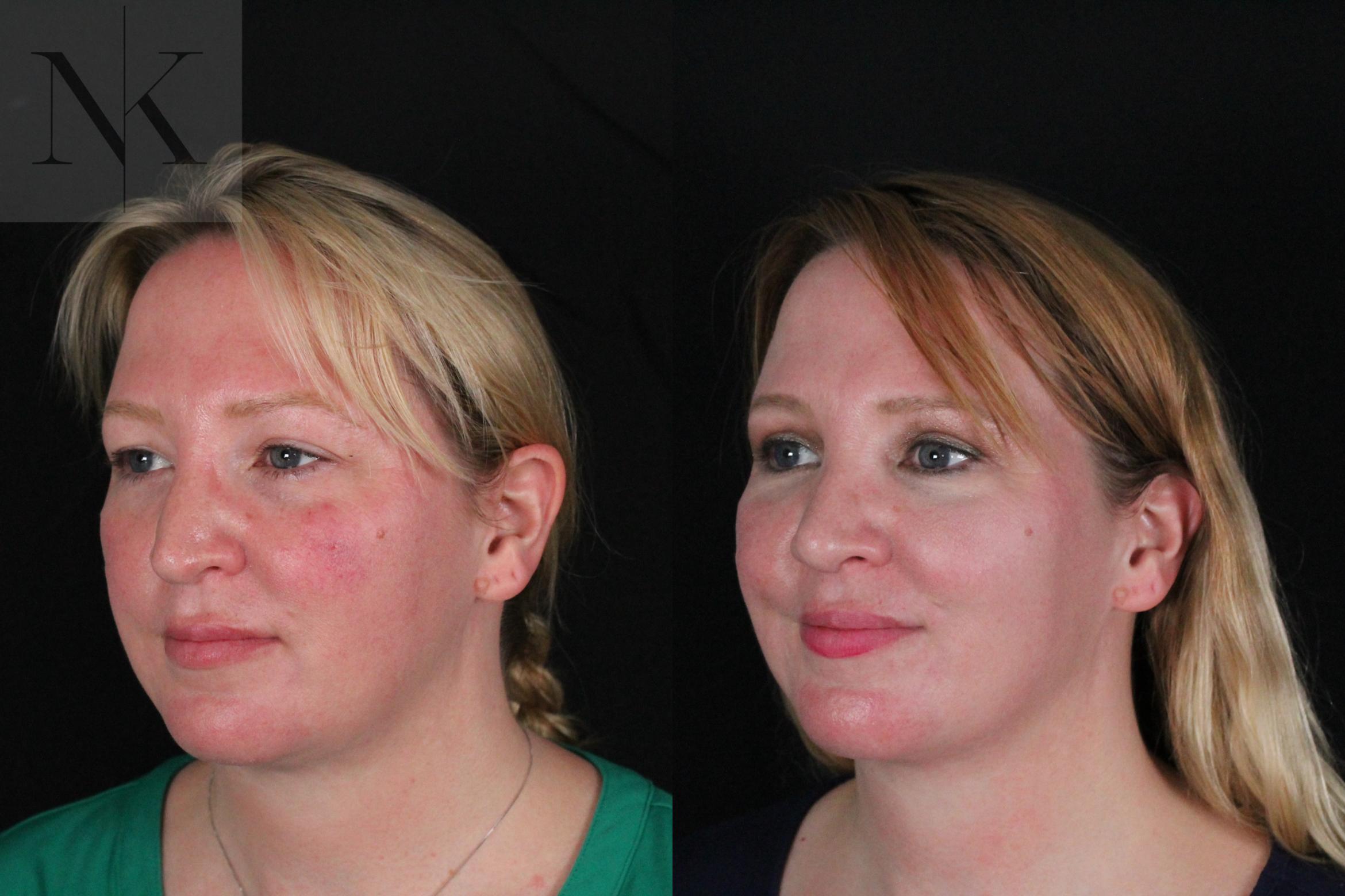 Before & After Rhinoplasty Case 188 Left Oblique View in Wethersfield, Hartford, Nebraska