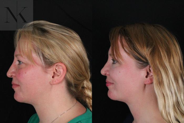 Before & After Rhinoplasty Case 188 Left Side View in Wethersfield, Hartford, Nebraska