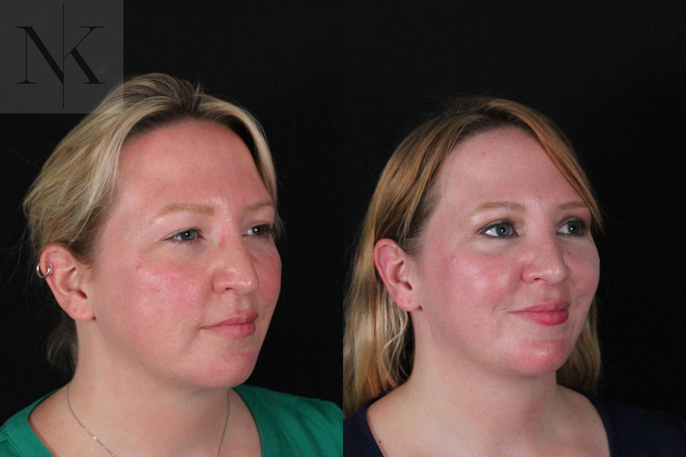 Before & After Rhinoplasty Case 188 Right Oblique View in Wethersfield, Hartford, Nebraska