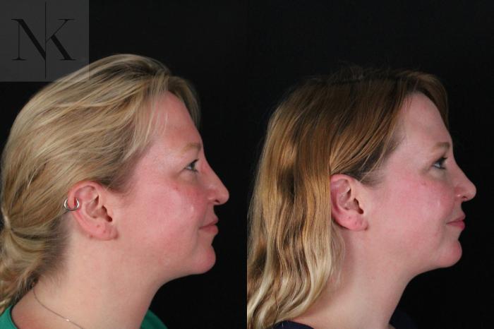 Before & After Rhinoplasty Case 188 Right Side View in Wethersfield, Hartford, Nebraska