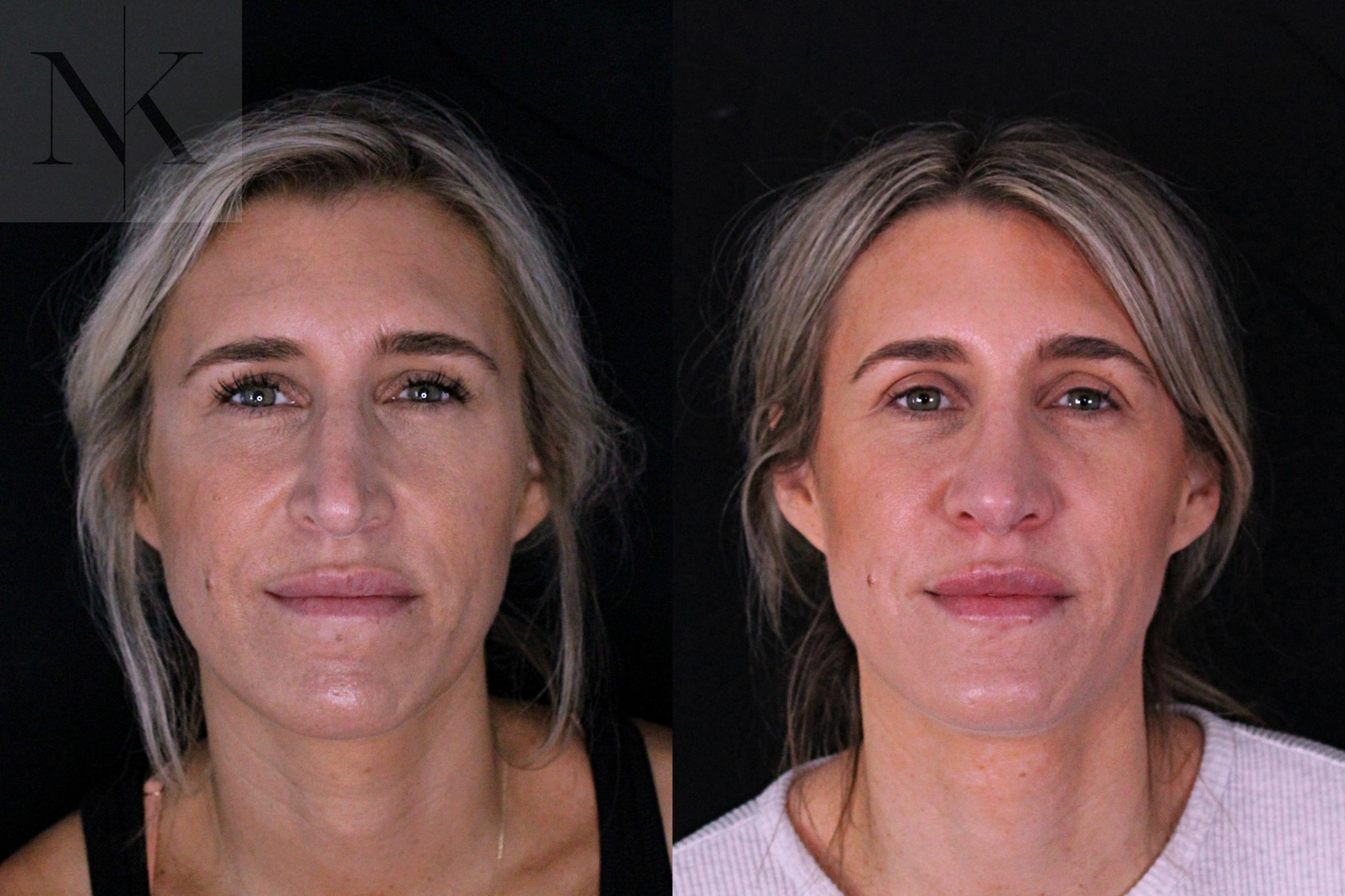 Before & After Rhinoplasty Case 204 Front View in Wethersfield, Hartford, Nebraska