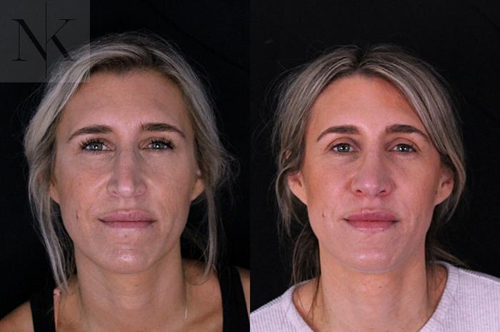 Before & After Rhinoplasty Case 204 Front View in Wethersfield, Hartford, Nebraska