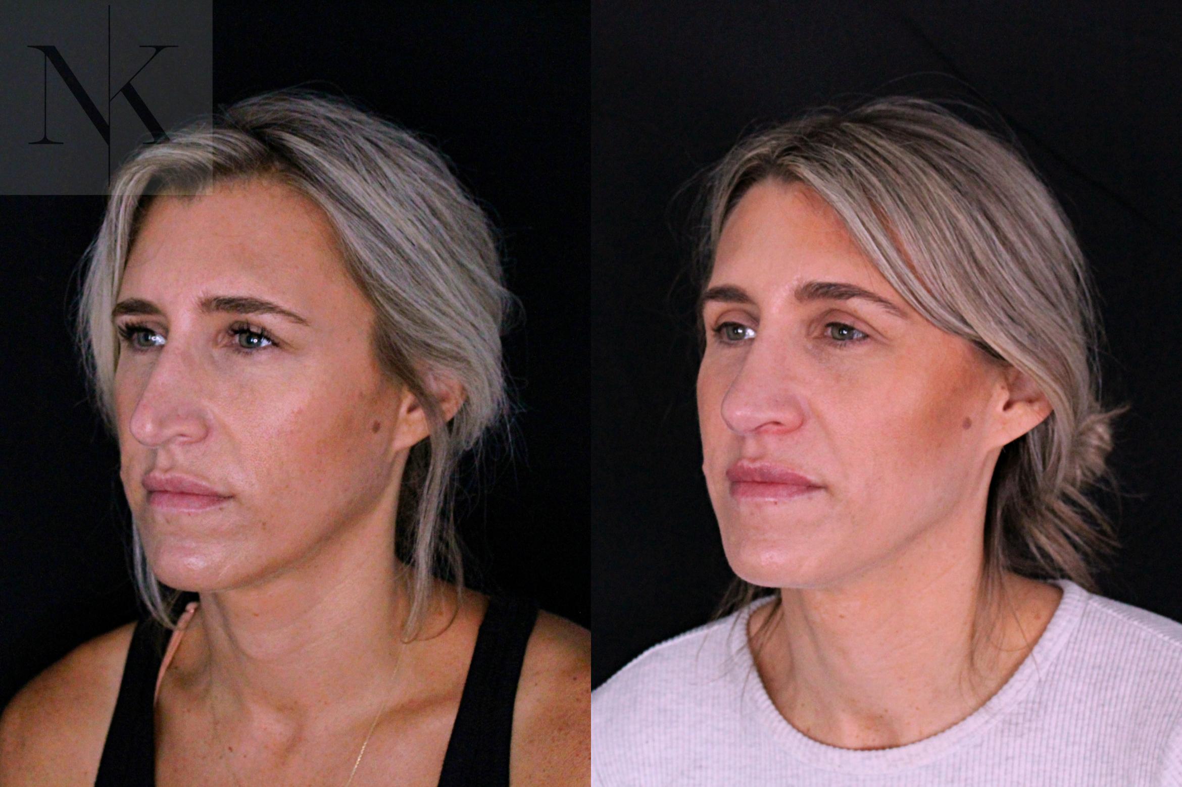 Before & After Rhinoplasty Case 204 Left Oblique View in Wethersfield, Hartford, Nebraska