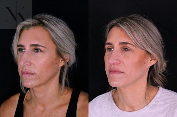 Before & After Rhinoplasty Case 204 Left Oblique View in Wethersfield, Hartford, Nebraska