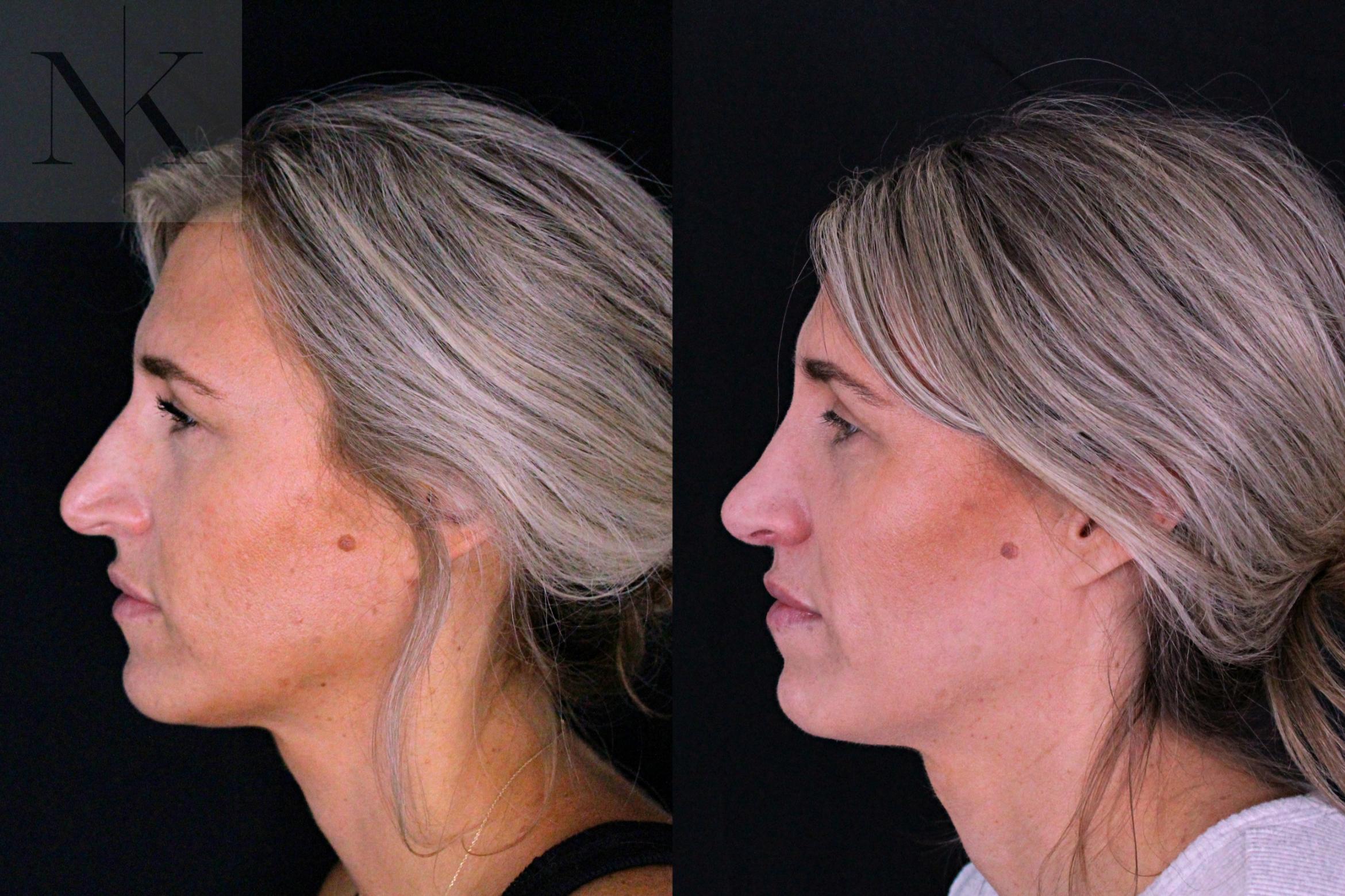 Before & After Rhinoplasty Case 204 Left Side View in Wethersfield, Hartford, Nebraska