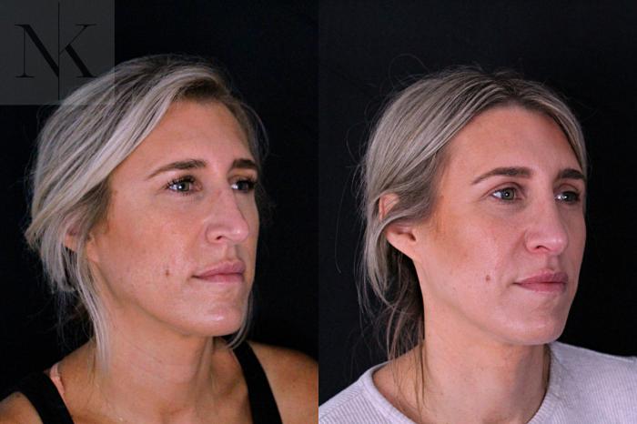 Before & After Rhinoplasty Case 204 Right Oblique View in Wethersfield, Hartford, Nebraska