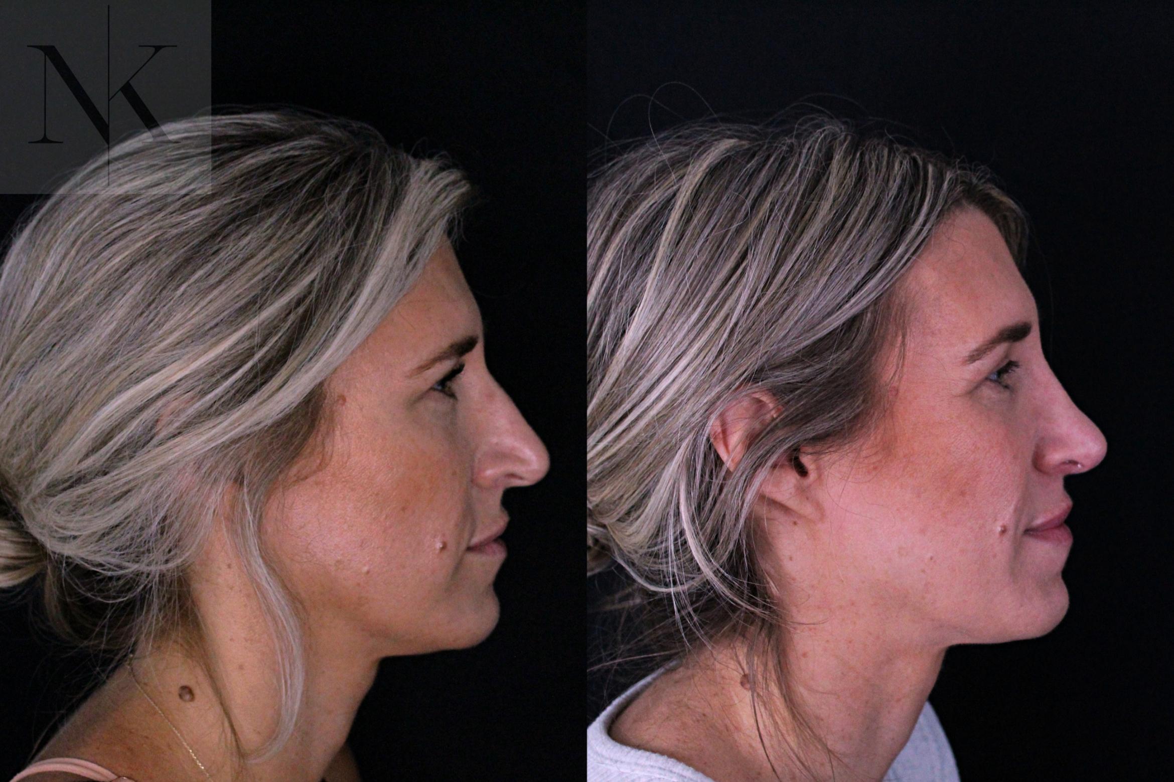 Before & After Rhinoplasty Case 204 Right Side View in Wethersfield, Hartford, Nebraska