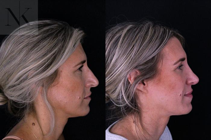 Before & After Rhinoplasty Case 204 Right Side View in Wethersfield, Hartford, Nebraska
