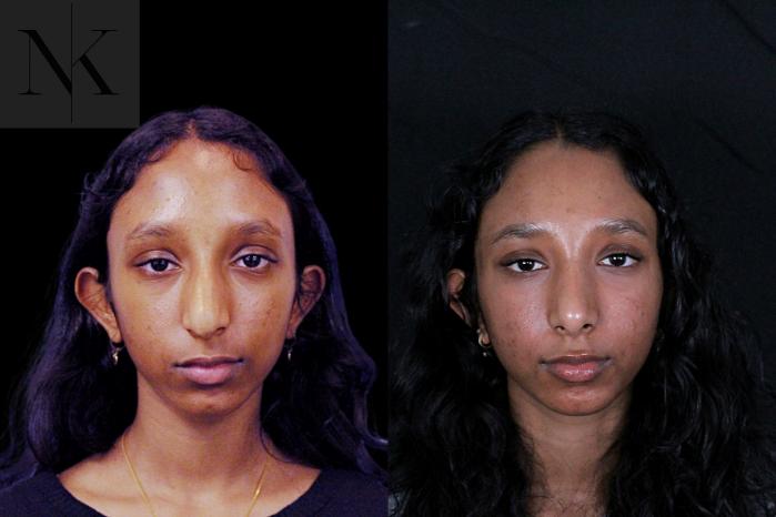 Before & After Rhinoplasty Case 205 Front View in Wethersfield, Hartford, Nebraska