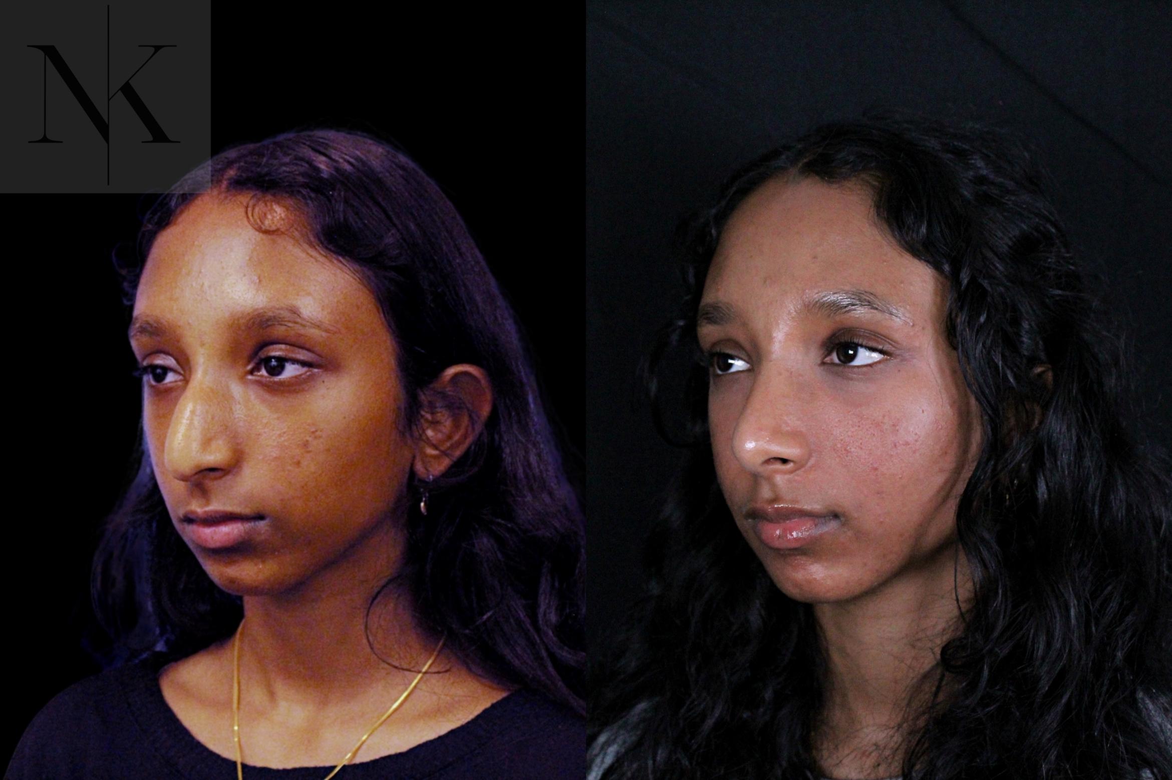 Before & After Rhinoplasty Case 205 Left Oblique View in Wethersfield, Hartford, Nebraska