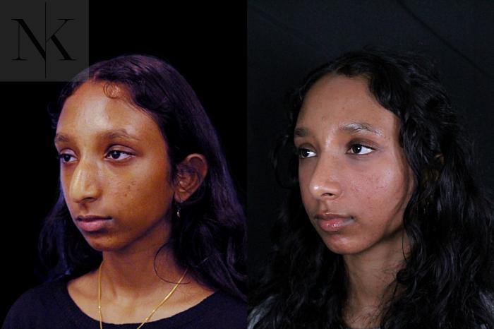 Before & After Rhinoplasty Case 205 Left Oblique View in Wethersfield, Hartford, Nebraska