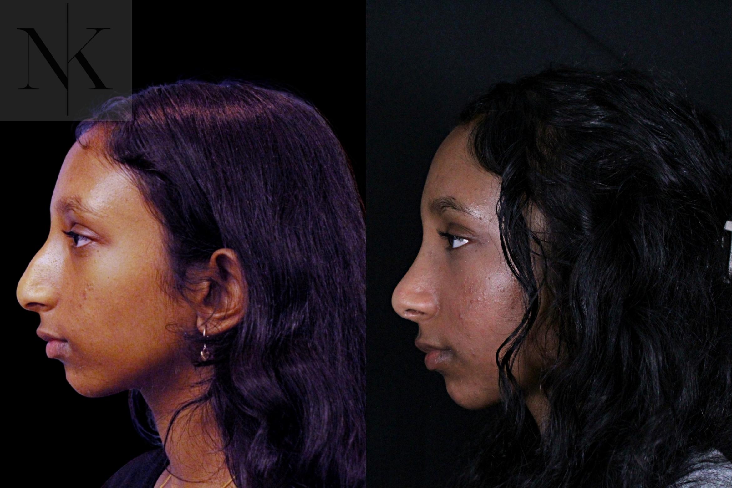 Before & After Rhinoplasty Case 205 Left Side View in Wethersfield, Hartford, Nebraska