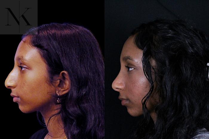 Before & After Rhinoplasty Case 205 Left Side View in Wethersfield, Hartford, Nebraska