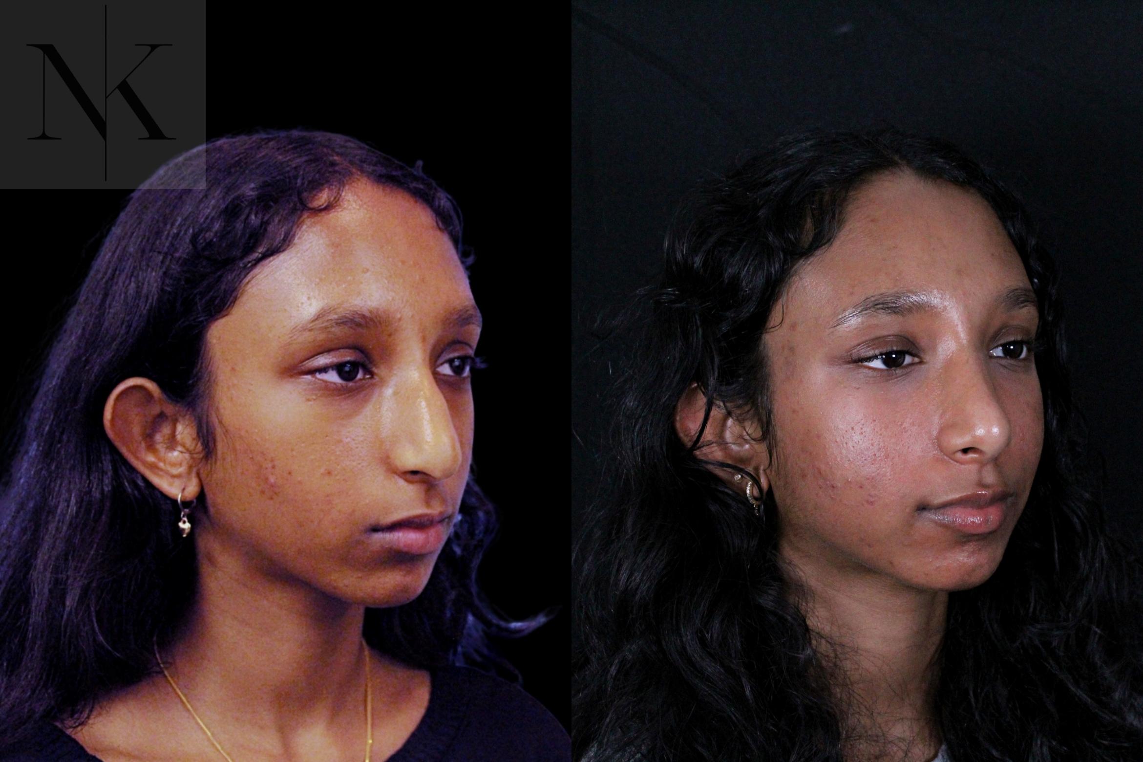 Before & After Rhinoplasty Case 205 Right Oblique View in Wethersfield, Hartford, Nebraska
