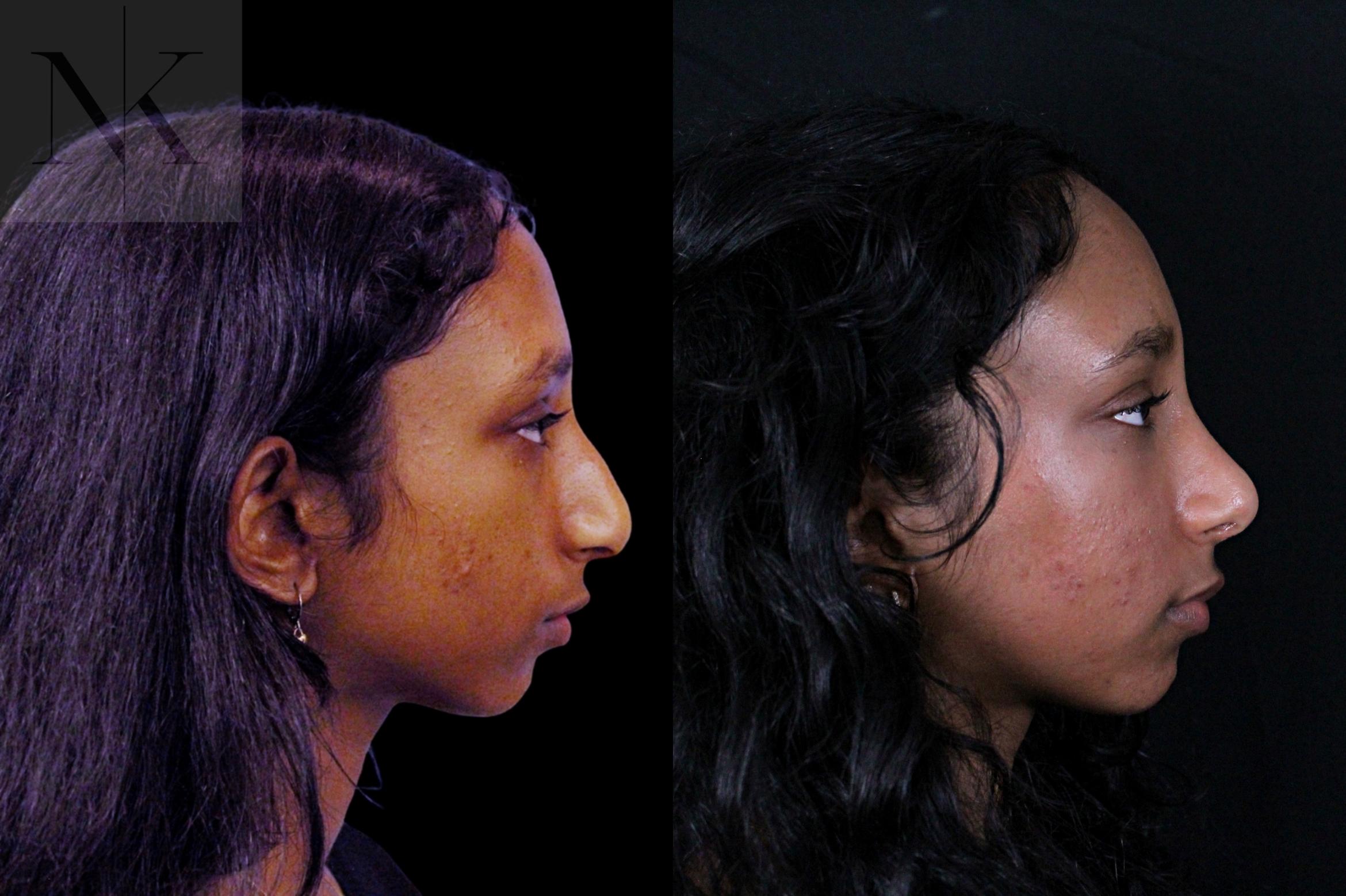 Before & After Rhinoplasty Case 205 Right Side View in Wethersfield, Hartford, Nebraska