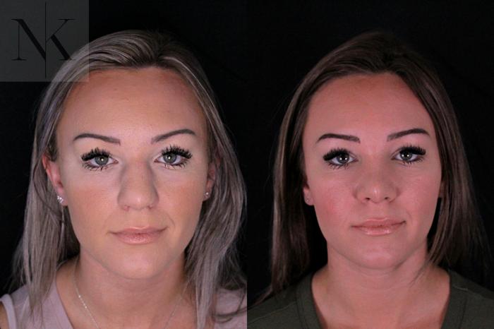 Before & After Rhinoplasty Case 206 Front View in Wethersfield, Hartford, Nebraska